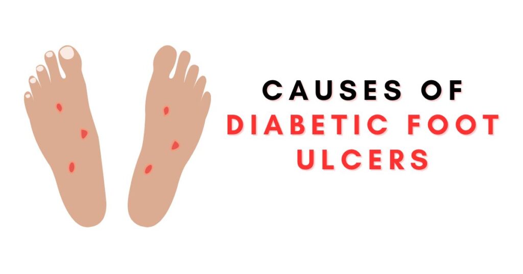 Causes of Diabetic Foot Ulcers