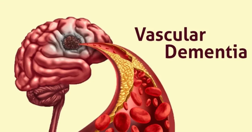 What is  Vascular Dementia