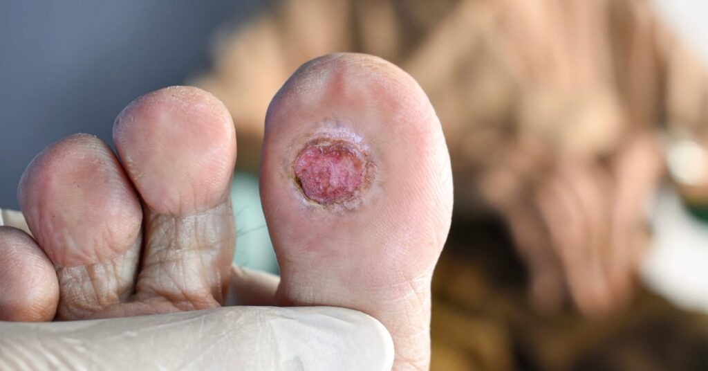 What is a diabetic foot ulcers